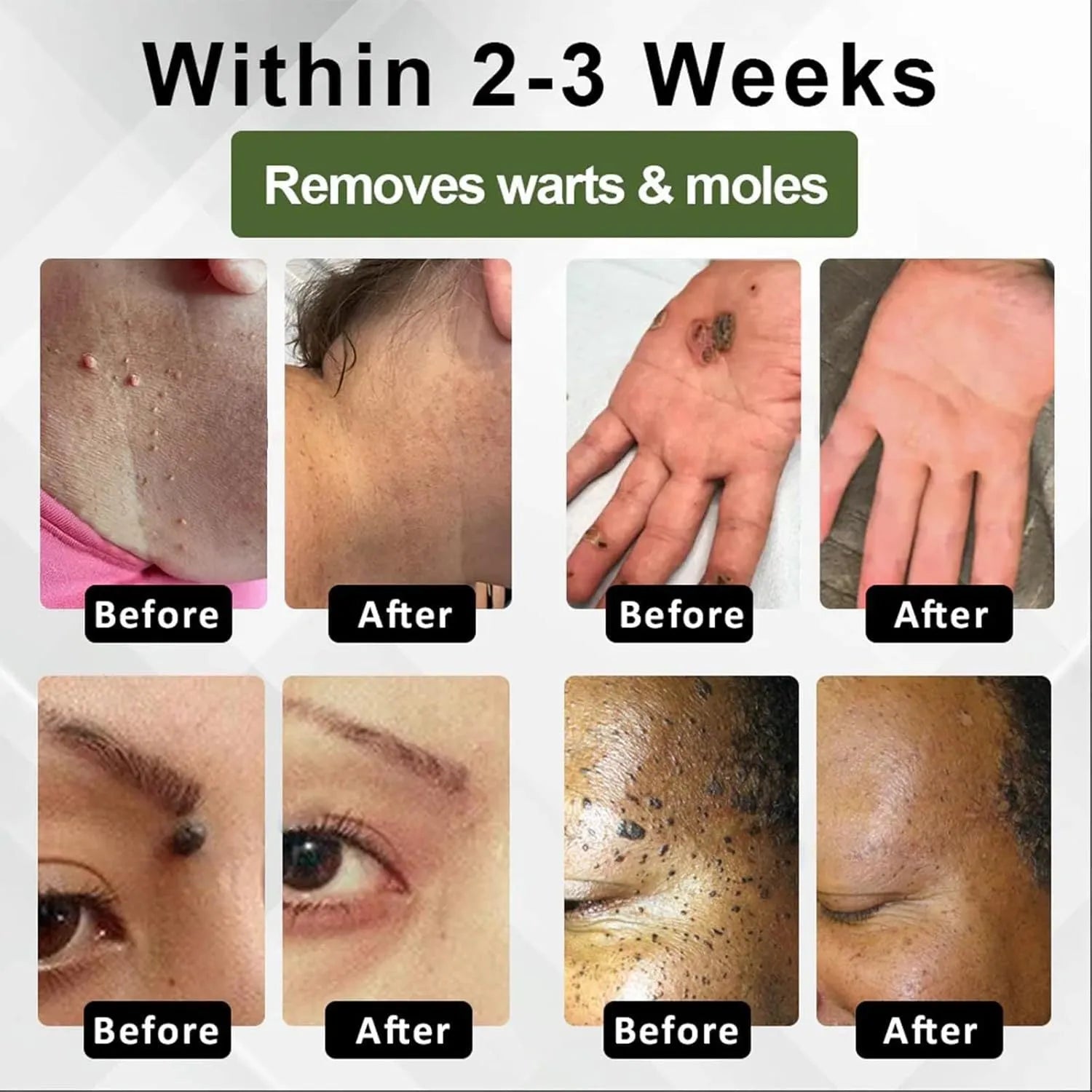 Natureerase Instant Mole Spot Removal Gel in 45g tube for facial skin blemish treatment