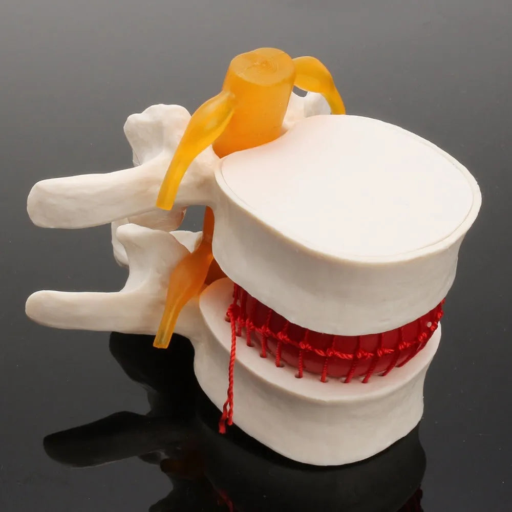 White PVC lumbar intervertebral disc herniation demonstration model measuring 11x10x7.6cm