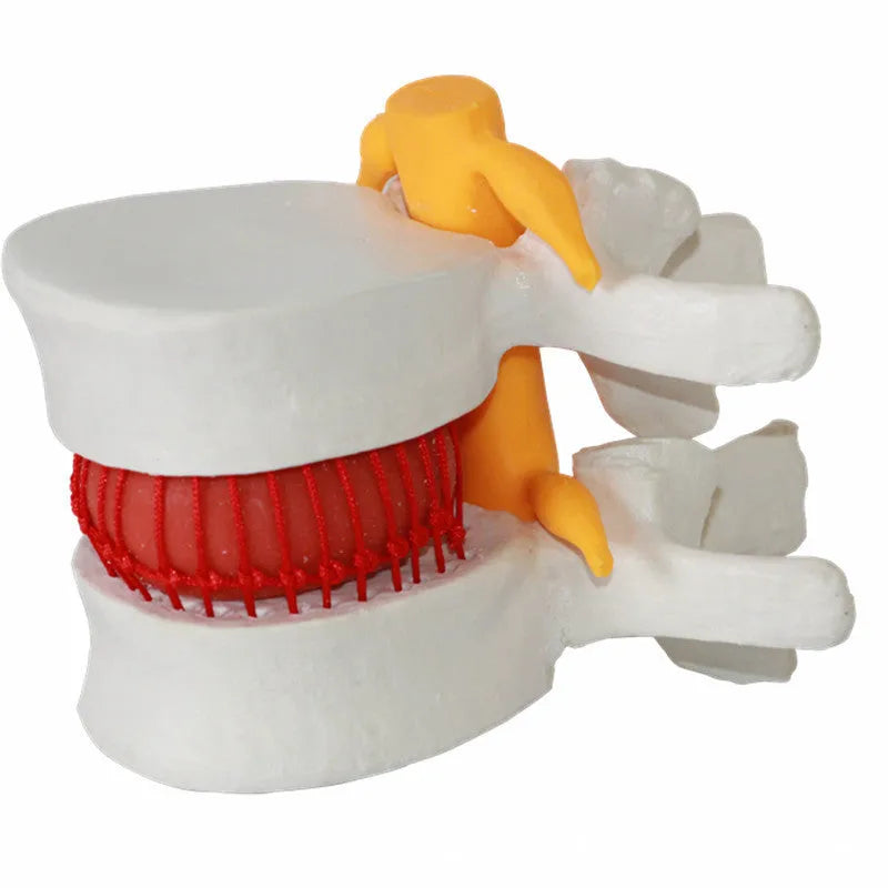 White PVC lumbar intervertebral disc herniation demonstration model measuring 11x10x7.6cm