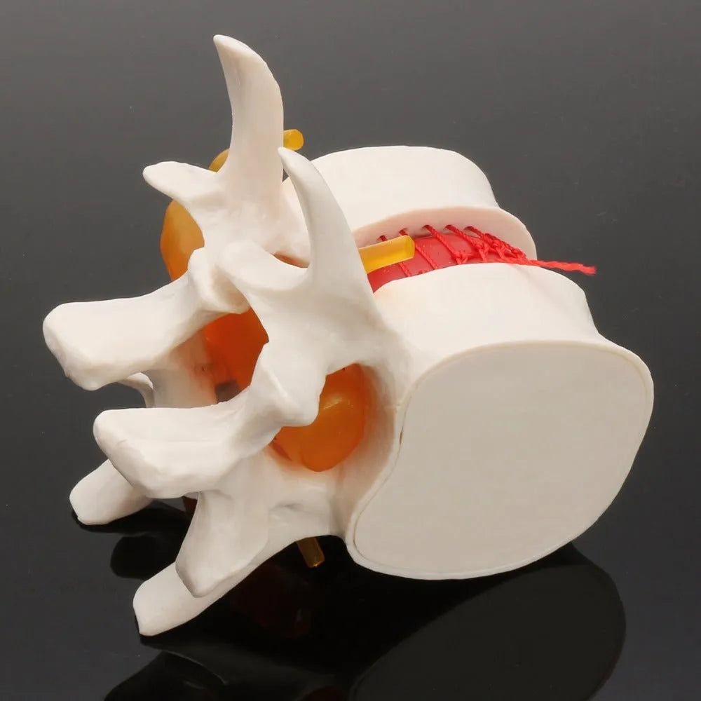White PVC lumbar intervertebral disc herniation demonstration model measuring 11x10x7.6cm