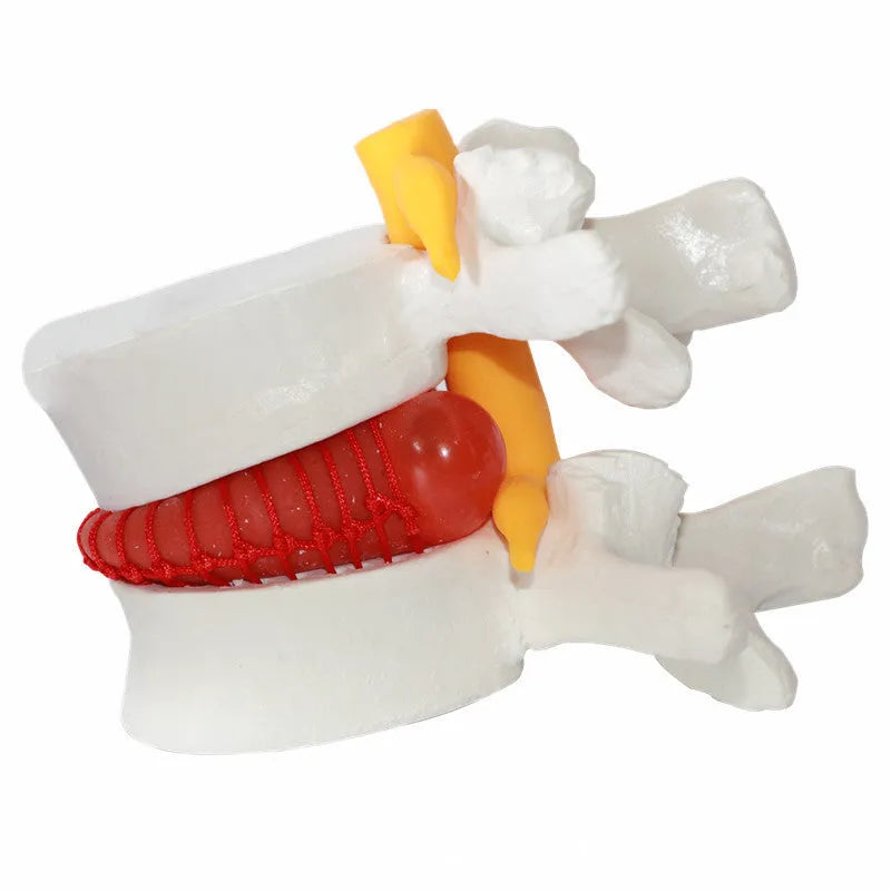 White PVC lumbar intervertebral disc herniation demonstration model measuring 11x10x7.6cm