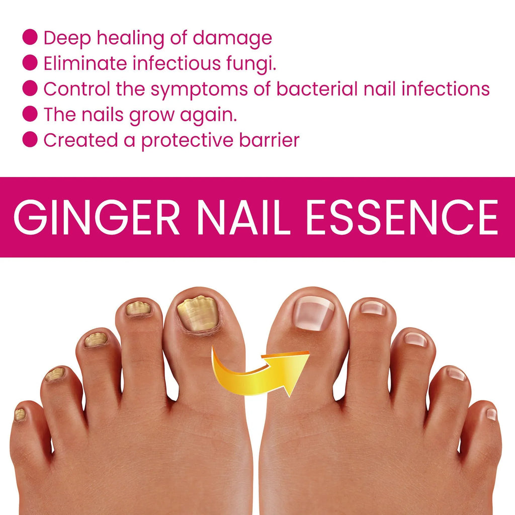 Ginger nail care essence 10ml bottle with dropper, showcasing clear liquid formula