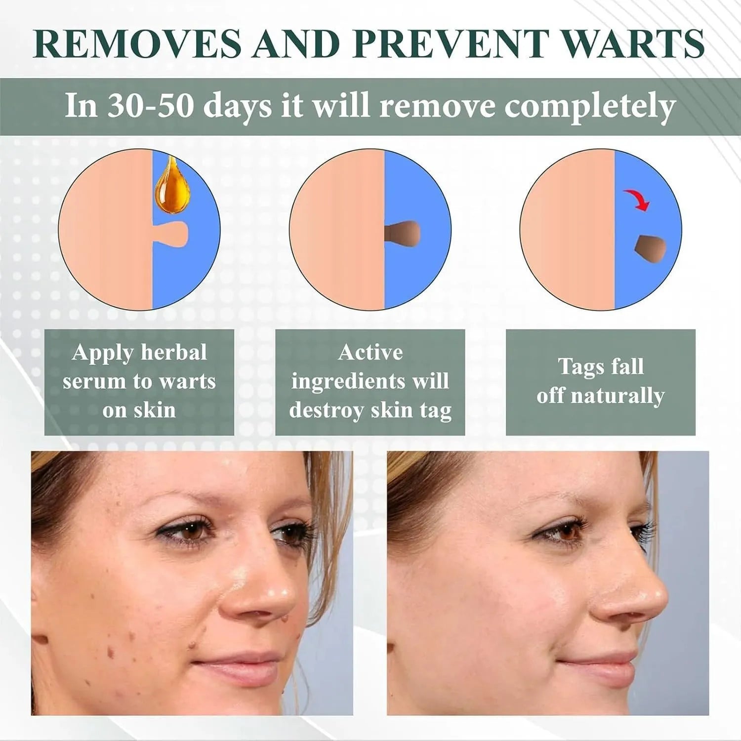 Natureerase Instant Mole Spot Removal Gel in 45g tube for facial skin blemish treatment