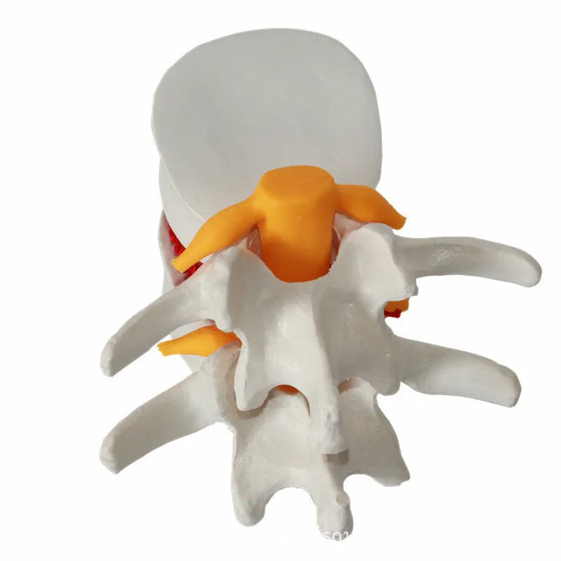 White PVC lumbar intervertebral disc herniation demonstration model measuring 11x10x7.6cm