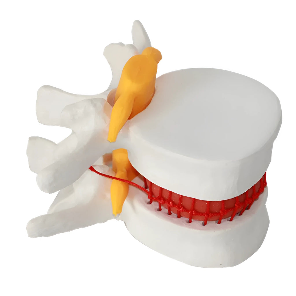 White PVC lumbar intervertebral disc herniation demonstration model measuring 11x10x7.6cm