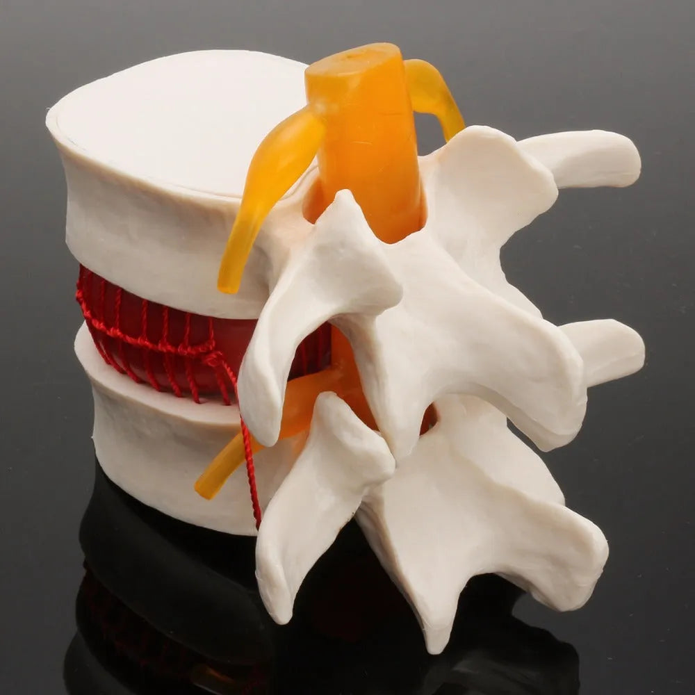 White PVC lumbar intervertebral disc herniation demonstration model measuring 11x10x7.6cm