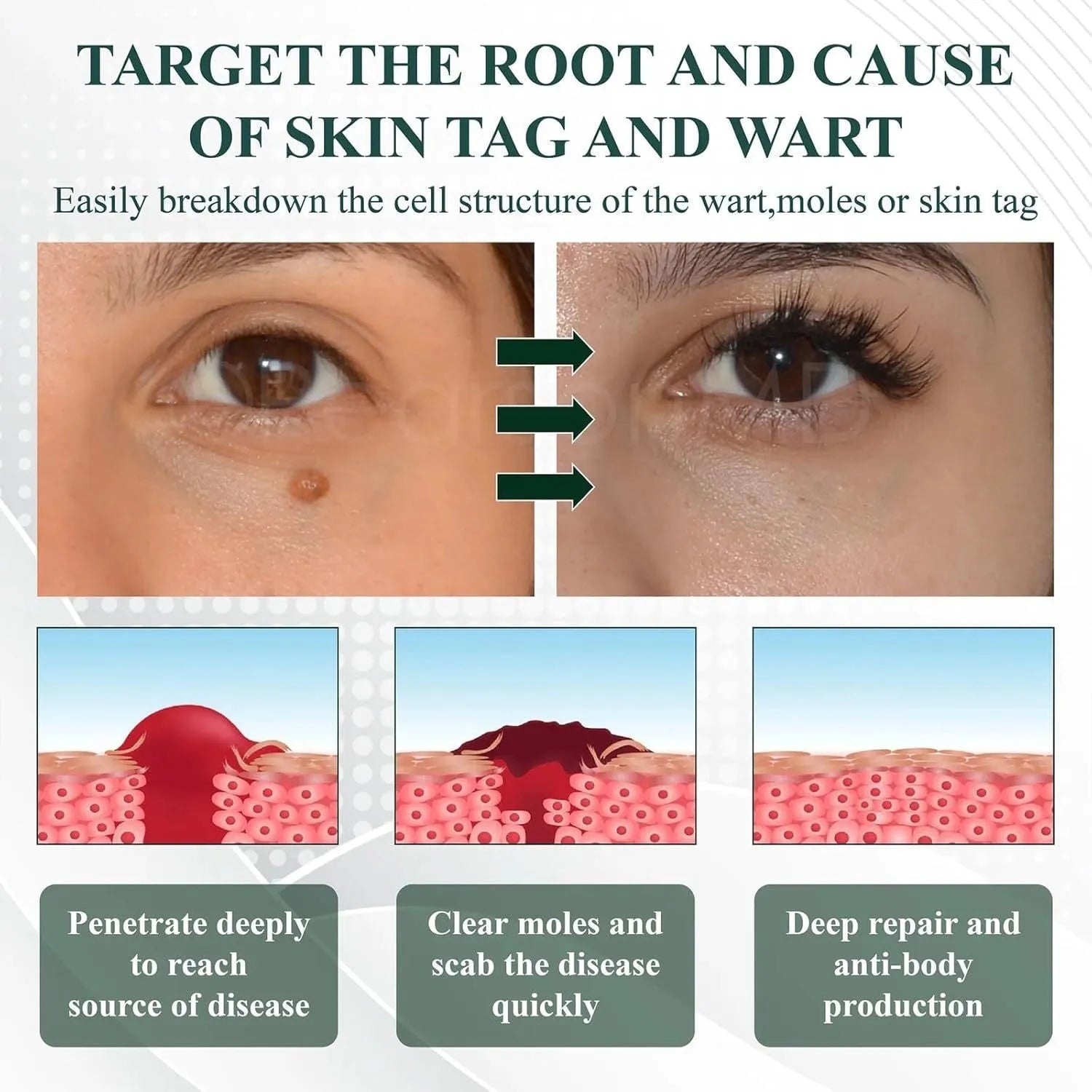 Natureerase Instant Mole Spot Removal Gel in 45g tube for facial skin blemish treatment