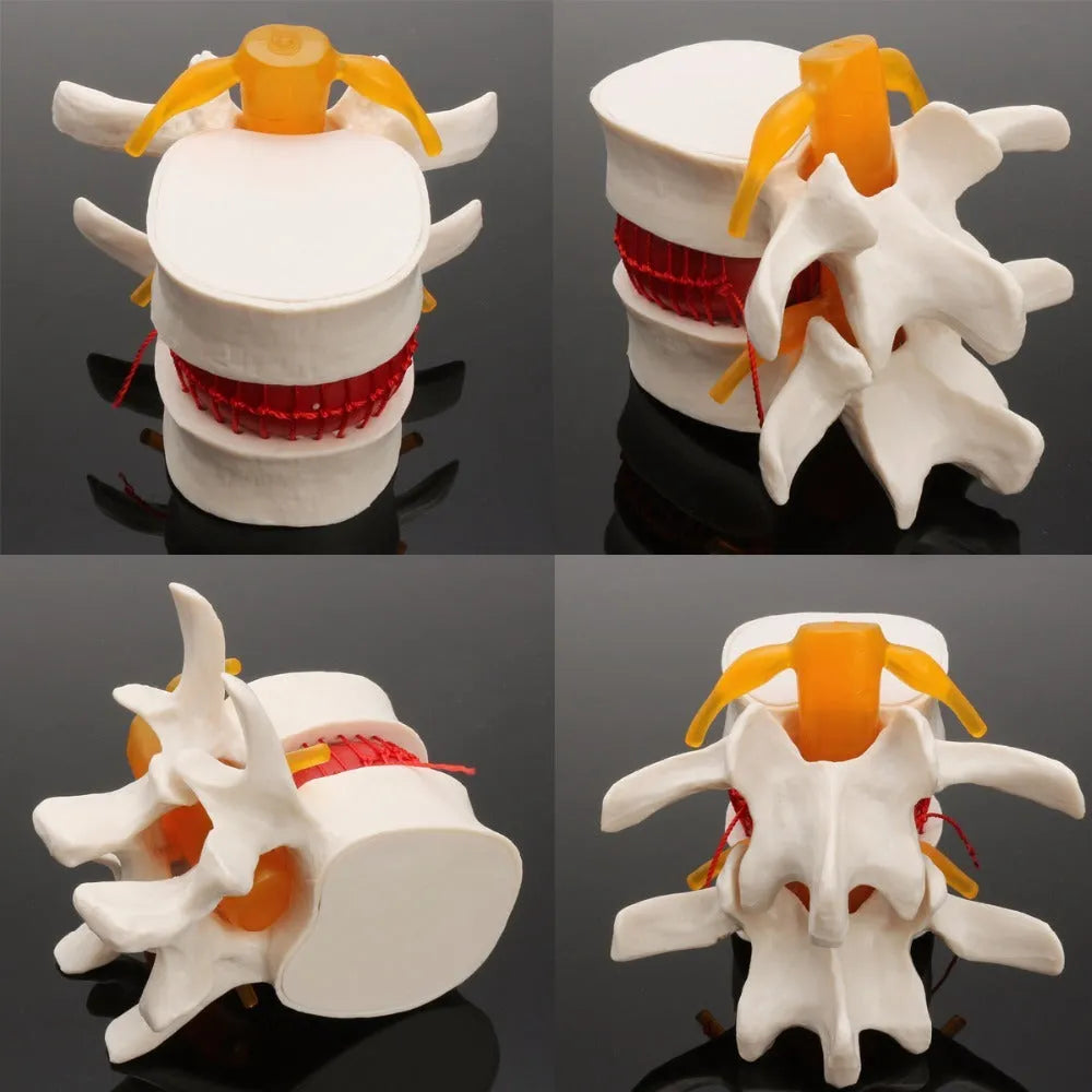 White PVC lumbar intervertebral disc herniation demonstration model measuring 11x10x7.6cm