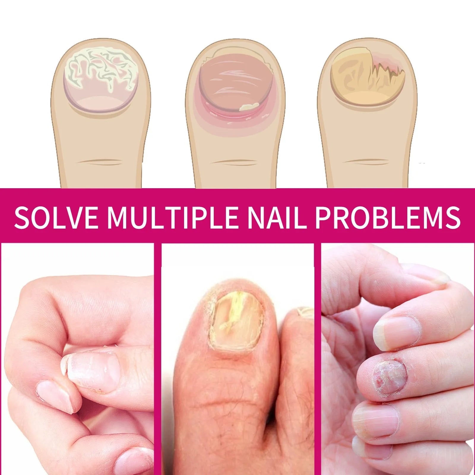 Ginger nail care essence 10ml bottle with dropper, showcasing clear liquid formula